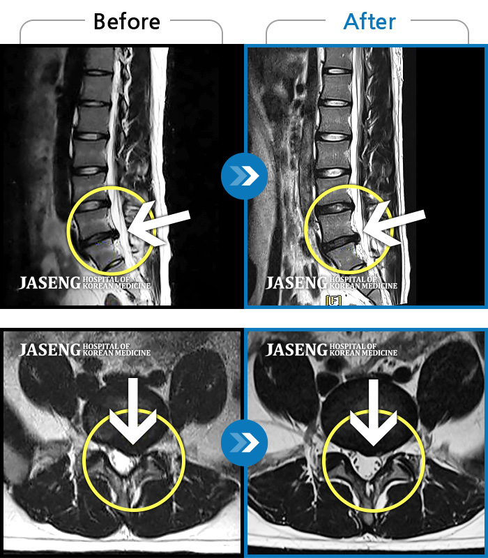 자생한방병원 치료사례 MRI로 보는 치료결과-좌측 허리부터 골반 통증, 좌측 다리까지 이어지는 저림
