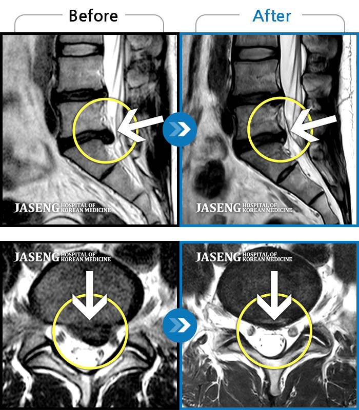 자생한방병원 치료사례 MRI로 보는 치료결과-수년간 지속되어온 만성적인 허리통증이 최근 들이 치료에도 반응하지 않고 더욱 심해졌다.