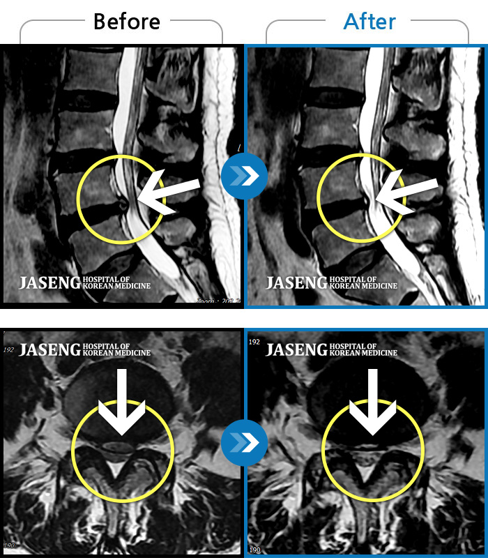 자생한방병원 치료사례 MRI로 보는 치료결과-심한 왼쪽 엉치 통증. 종아리, 발바닥 저림