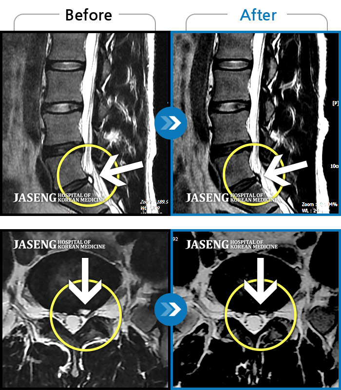 자생한방병원 치료사례 MRI로 보는 치료결과-심한 허리 통증