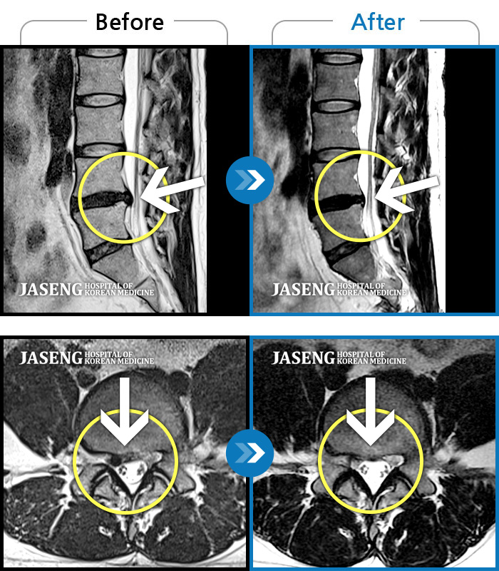자생한방병원 치료사례 MRI로 보는 치료결과-디스크 탈출로 인한 근력저하 및 감각저하