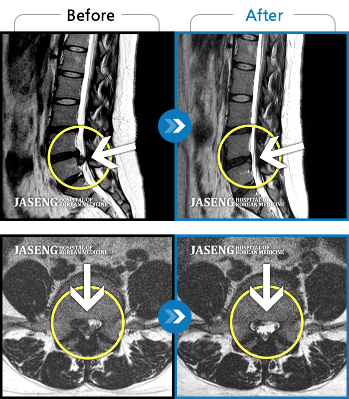 자생한방병원 치료사례 MRI로 보는 치료결과-디스크가 터져 수핵이 흘러내려 우측 발등의 감각 저하와 엄지발가락 굴곡 근력까지 떨어져 있는 심각한 상태였습니다.