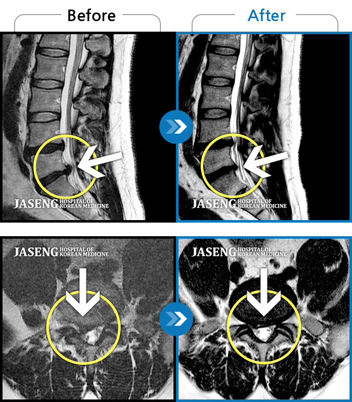자생한방병원 치료사례 MRI로 보는 치료결과-오른쪽 종아리 통증이 너무 심해서 수술 권유 받고 왔어요