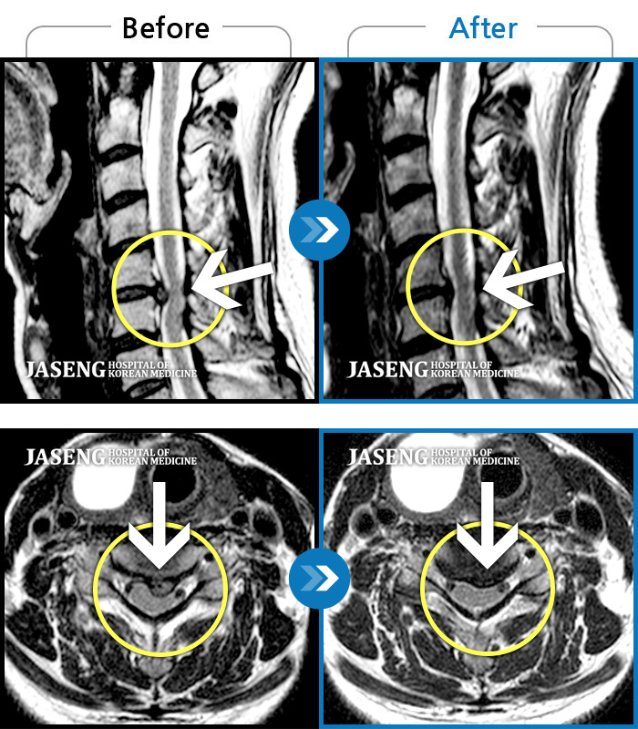 자생한방병원 치료사례 MRI로 보는 치료결과-목부터 좌측 어깨까지 통증이 심해요