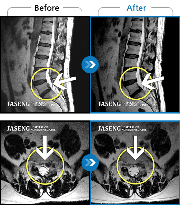 자생한방병원 치료사례 MRI로 보는 치료결과-엉치에서 좌측 다리 뒤쪽으로 통증과 저림이 매우 심해요.