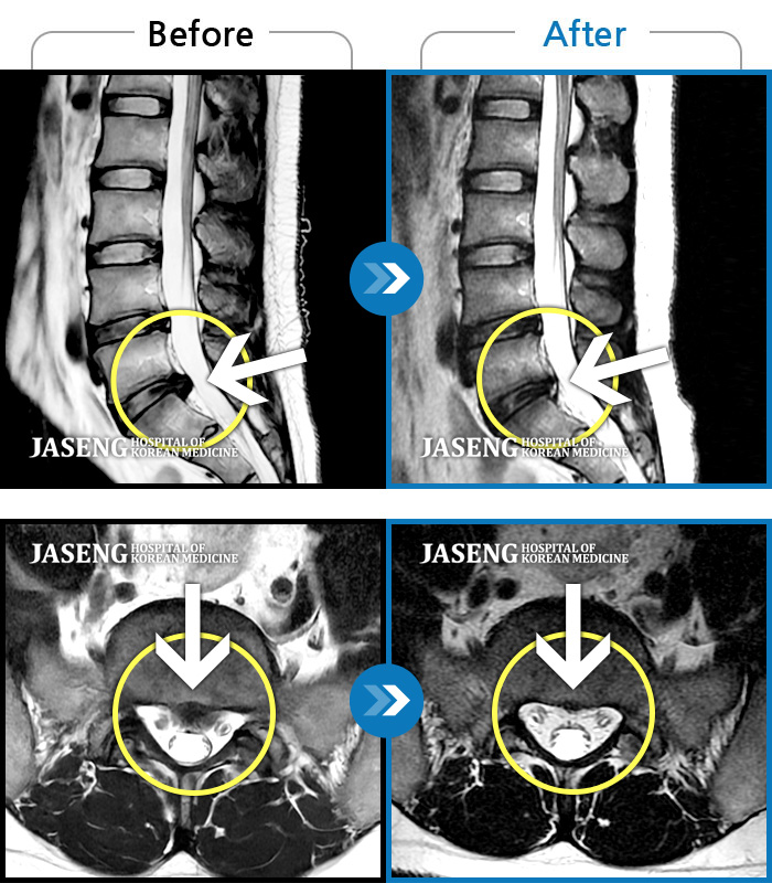 자생한방병원 치료사례 MRI로 보는 치료결과-좌측 허리통증과 하지방사통으로 밤에 잠을 자지못하고 걷기 힘들었다.