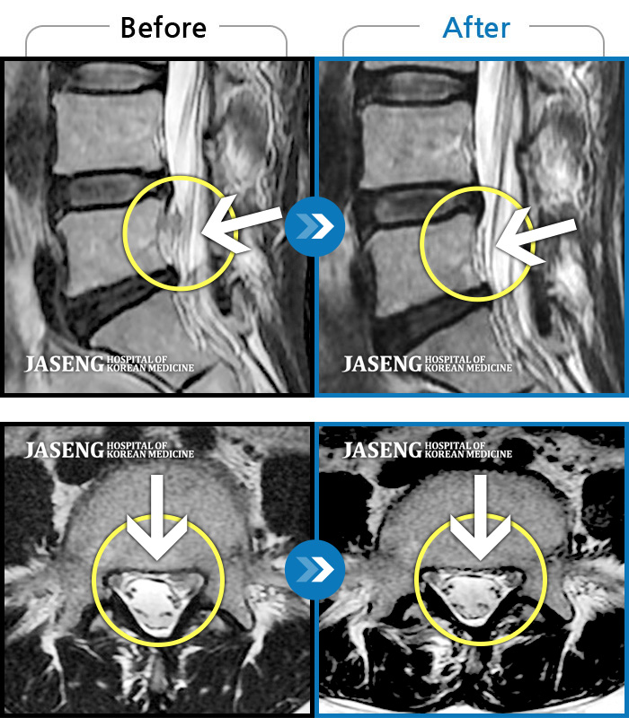 자생한방병원 치료사례 MRI로 보는 치료결과-푸쉬업을 여러 번 반복한 뒤 극심한 하요부 통증 및 우측 하지부 저림