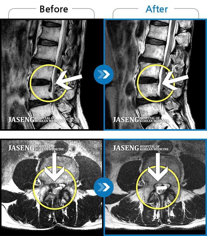 자생한방병원 치료사례 MRI로 보는 치료결과-양측 하요추부 통증과 우측 하지부 통증
