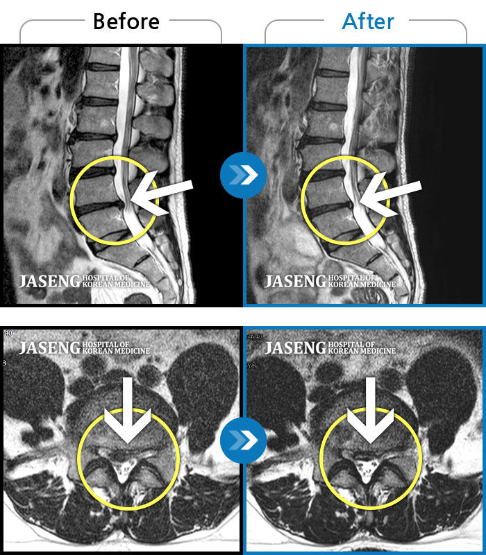 자생한방병원 치료사례 MRI로 보는 치료결과-우측 허리 통증 및 다리 저림이 심하여 앉거나  바로 눕는 것도 힘든 상태로 내원하셨습니다. 감각 저하도 동반되어 심각한 신경손상이 의심되는 상황이었습니다.