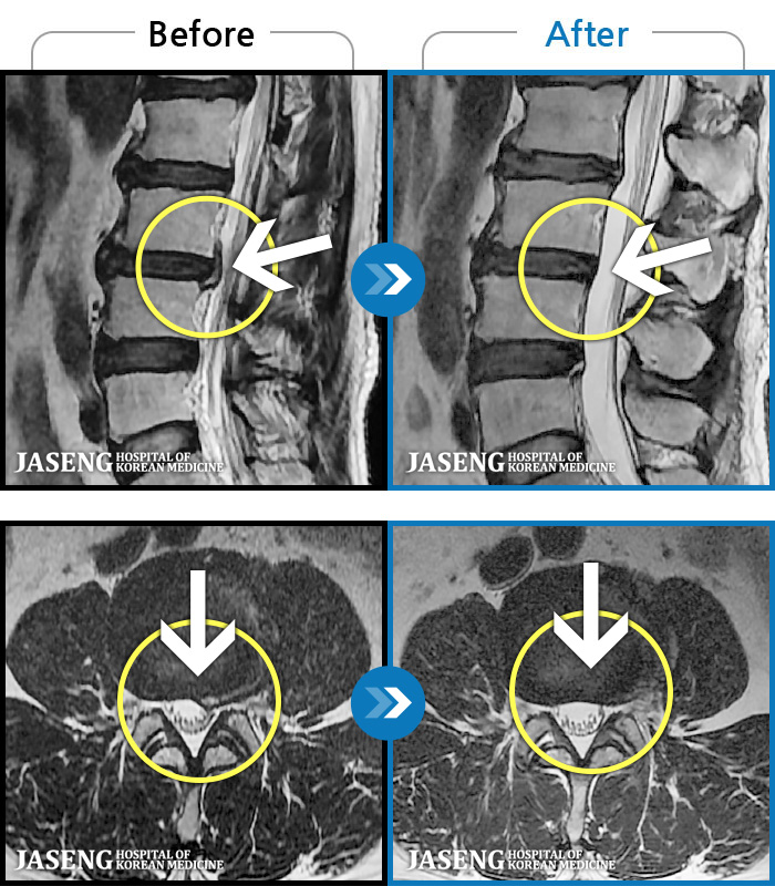 자생한방병원 치료사례 MRI로 보는 치료결과-허리 골반 통증이 있고 허리를 숙일 때 불편합니다.