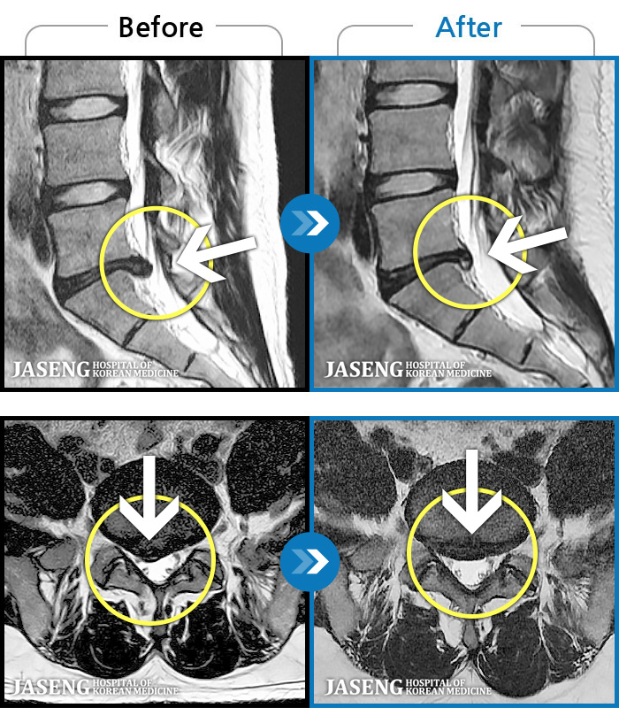자생한방병원 치료사례 MRI로 보는 치료결과-양측 엉덩이 저림 통증과 활동 시 허리 통증이  증가했습니다.