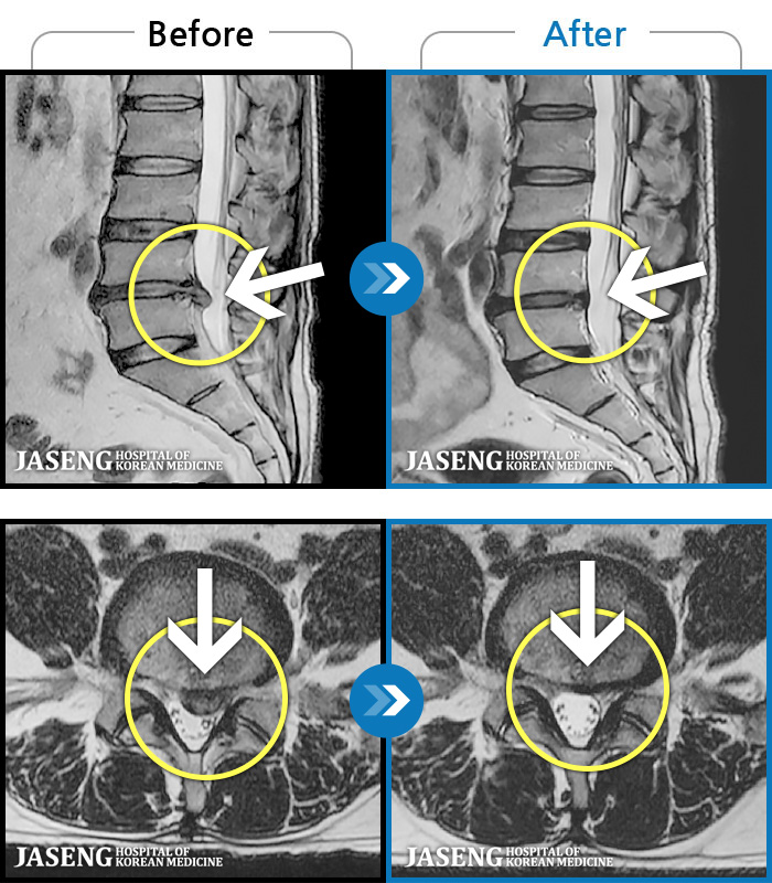 자생한방병원 치료사례 MRI로 보는 치료결과-내원 당시 추간판 탈출증으로 인한 요 골반통과 좌측 하지 방사 통으로 보행 및 일생 상활이 어려웠습니다.