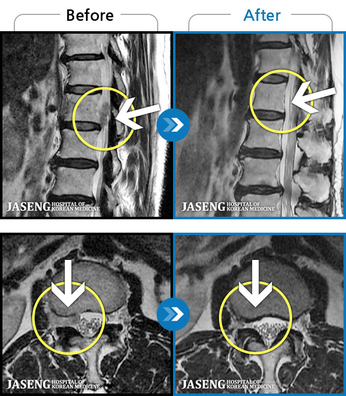 자생한방병원 치료사례 MRI로 보는 치료결과-아래쪽 허리와 우측 골반에 통증이 있었습니다.