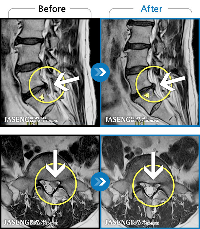 자생한방병원 치료사례 MRI로 보는 치료결과-좌측 골반 및 종아리부터 발까지 이어지는 저림과 통증으로 내원하셨습니다. 