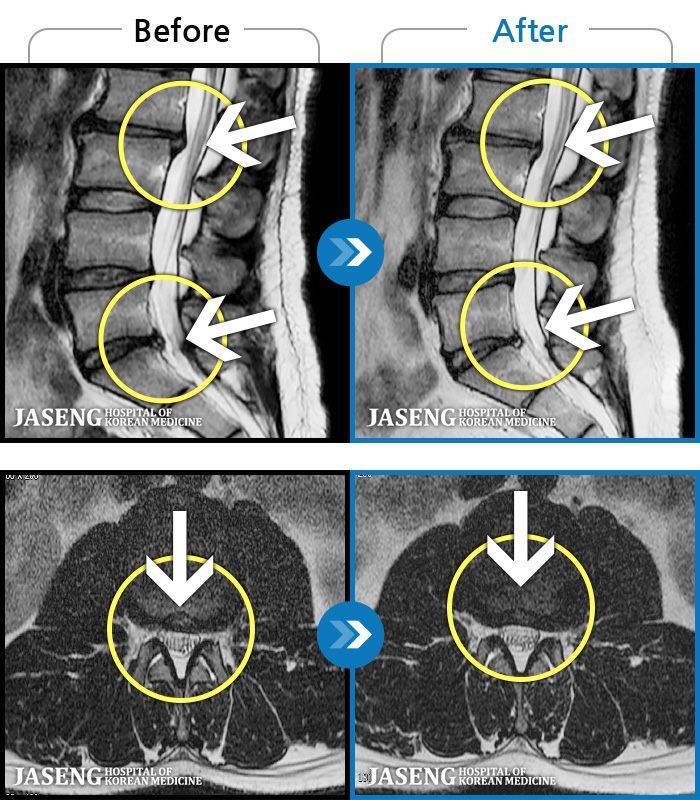 자생한방병원 치료사례 MRI로 보는 치료결과-물건을 들다 삐끗한 후 발생한 허리 통증 및 하지 방사통, 하지 감각 저하 및 근력 저하 발생