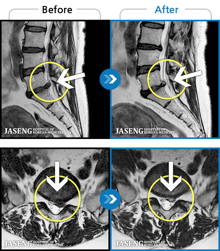 자생한방병원 치료사례 MRI로 보는 치료결과-허리 골반 통증이 있고 다리가 저리고 아파 걷기가 힘들다.
