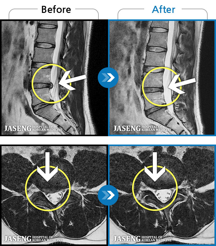 자생한방병원 치료사례 MRI로 보는 치료결과-우측 허리통증과 허리를 숙이면 허벅지 저림이 있다.