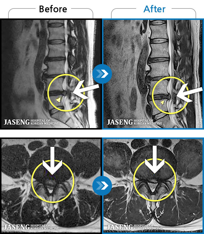 자생한방병원 치료사례 MRI로 보는 치료결과-허리부터 골반이 묵직하고 뻐근한 통증, 우측 허벅지까지 이어지는 저림 증상으로 내원하셨습니다.