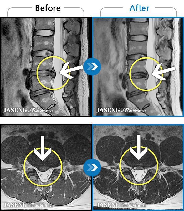 자생한방병원 치료사례 MRI로 보는 치료결과-심한 허리 통증으로 내원