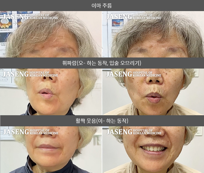 자생한방병원 치료사례 MRI로 보는 치료결과-오른쪽 얼굴이 마비되어서 눈이 잘 안감기고, 물 마실 때 물이 새어나가요.