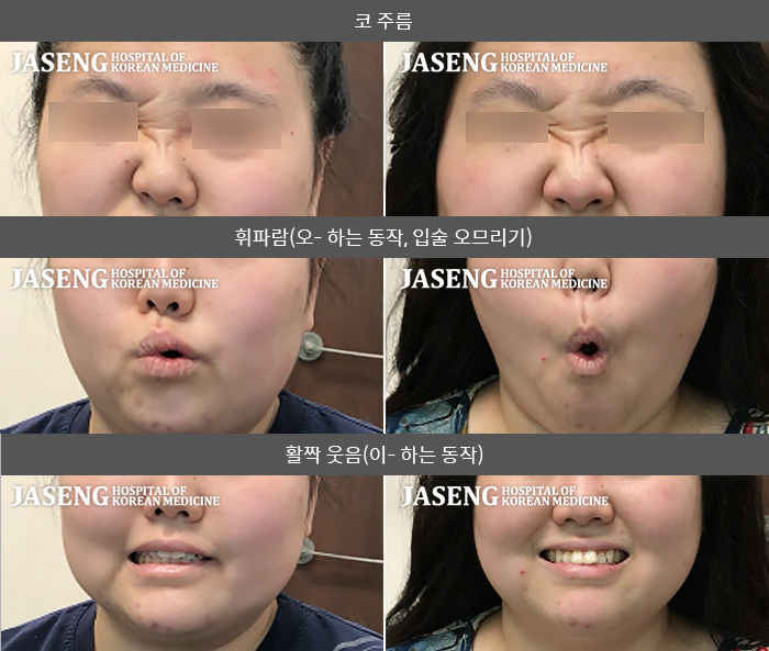 자생한방병원 치료사례 MRI로 보는 치료결과-좌측 안면마비, 귀뒤가 아파요