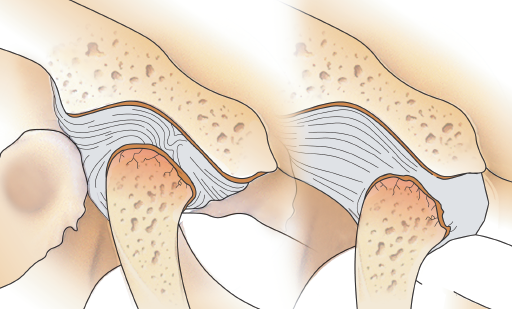 턱관절 디스크 전방전위