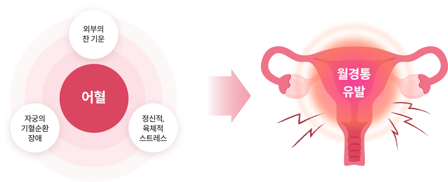 자궁의기혈순환장애,외부의 찬 기운, 정신정,육체적 스트레스 어혈 월경통유발
