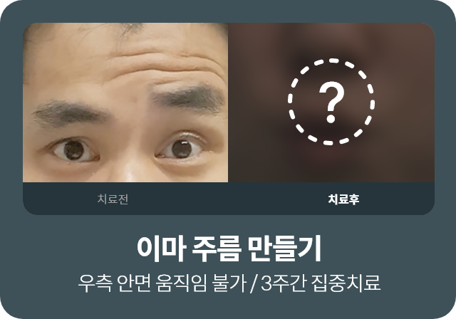 이마 주름 만들기 / 우측 안면 움직임 불가 / 3주간 집중치료