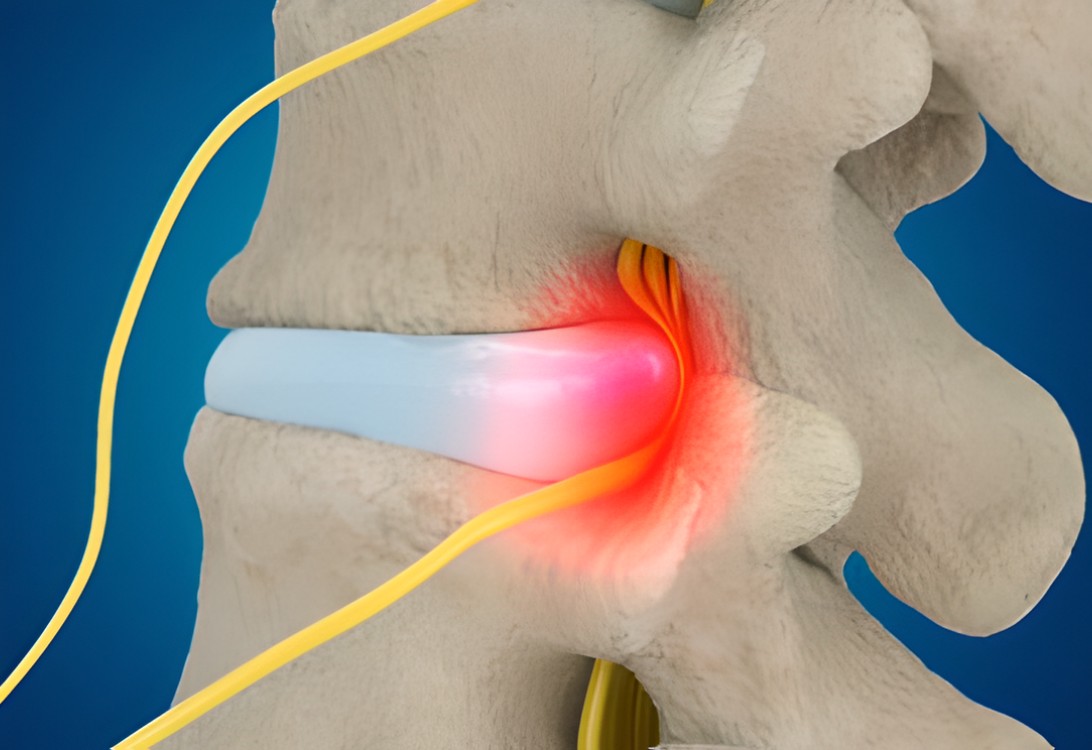 (2개월 이내) 중증 디스크