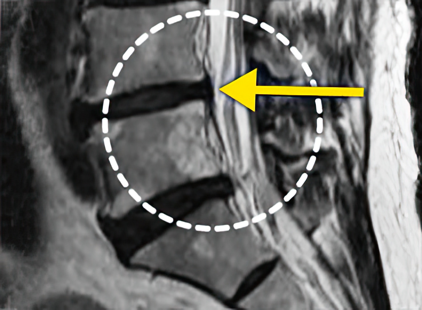터진디스크 한방통합치료 후