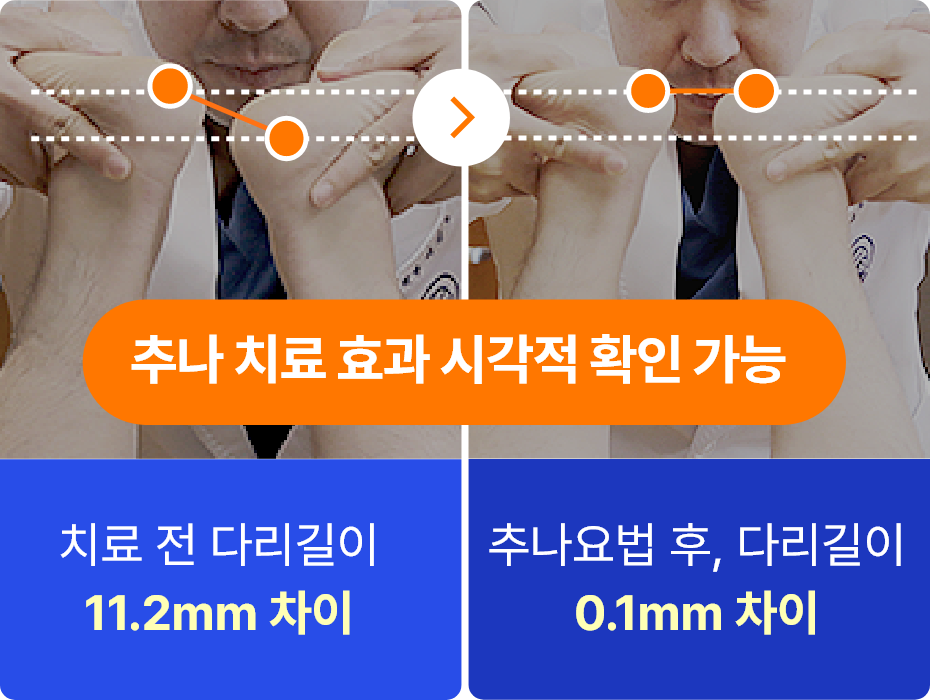 추나 치료 효과 , 치료 전 다리 길이 11.2mmc차이 추나요법 후 다리길이 0.1mm 차이 